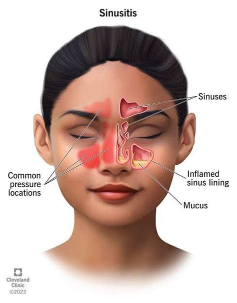 rhinosinusitis wikipedia|treatment of rhinosinusitis.